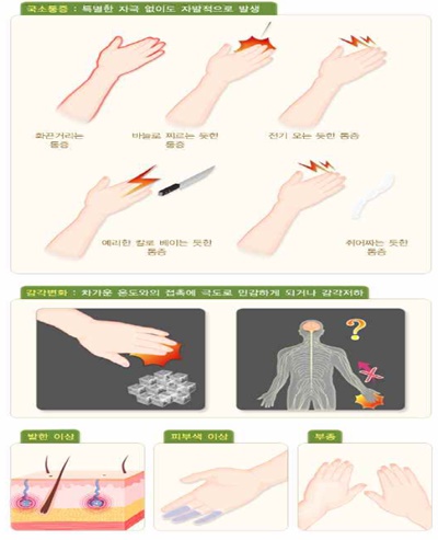 복합부위 통증증후군 증상.ⓒ한국장애인개발원