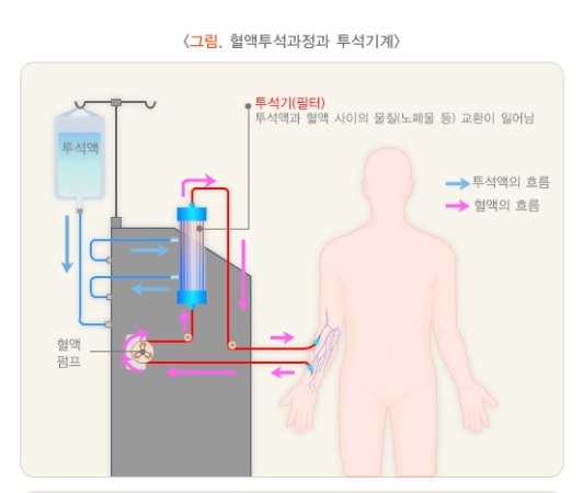 혈액투석과정. ⓒ네이버 지식백과